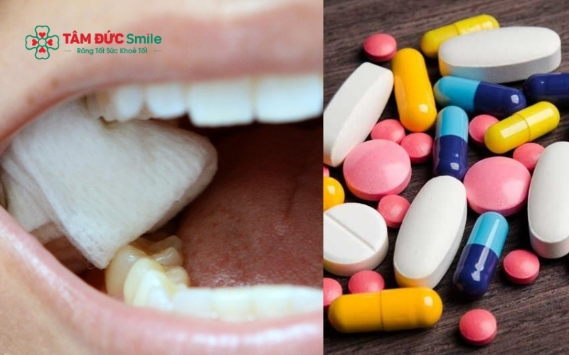 Cắn gạc đúng thời gian và dùng thuốc theo đơn bác sĩ là giải pháp giúp giảm sưng và xoa dịu cơn đau hiệu quả tại nhà.