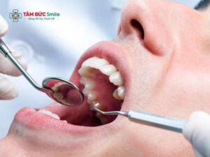 Nhổ răng số 8 có đau không? Đau mấy ngày?