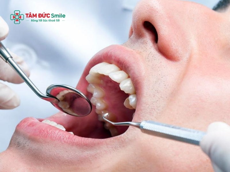Nhổ răng số 8 có đau không? Đau mấy ngày?