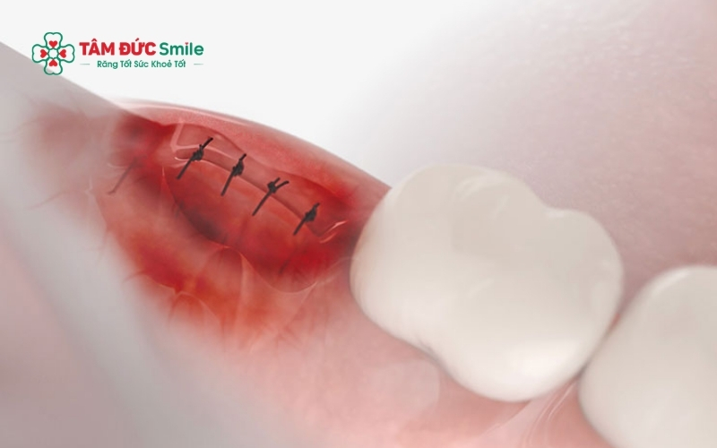 Răng số 6 và số 7 đảm nhận đến 90% chức năng ăn nhai, nên việc thiếu vắng răng số 8 không gây ảnh hưởng đến khả năng nghiền nát thức ăn.