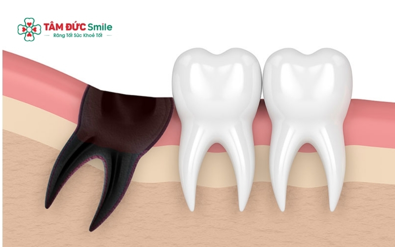 Khác với các răng khác, khoảng trống sau khi nhổ răng số 8 thường được để trống mà không cần phải thực hiện các biện pháp trồng lại.