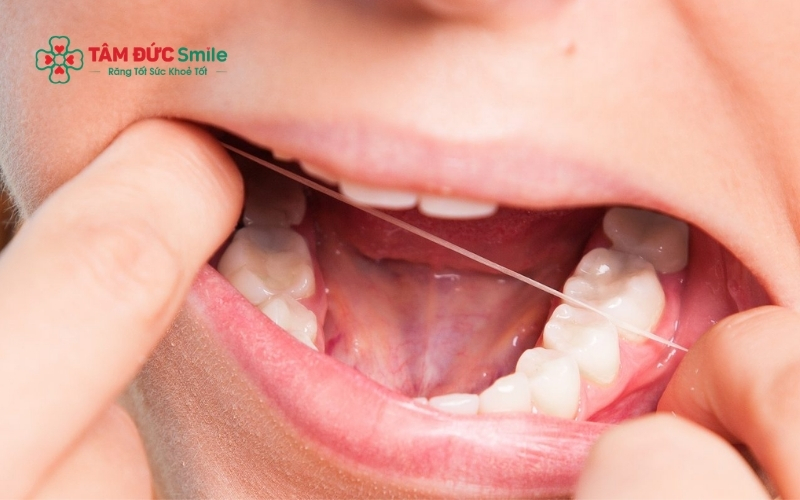 Do vị trí nằm sâu trong góc hàm, việc nhổ bỏ răng số 8 hoàn toàn không gây ra tình trạng hóp má hay làm thay đổi thẩm mỹ khuôn mặt.