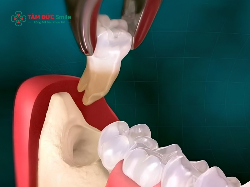 Nhổ răng số 8 có phải trồng lại không?
