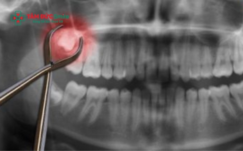 Răng số 8 mọc lệch, mọc ngầm đâm vào răng số 7 là nguyên nhân chính gây đau nhức kéo dài ngay cả sau khi đã nhổ bỏ