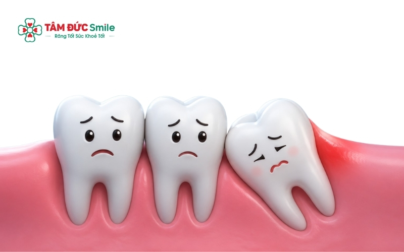 Răng số 7 và răng số 8 nằm kế cận nhau nên mọi tổn thương hoặc thay đổi ở răng khôn đều có thể ảnh hưởng trực tiếp đến răng hàm số 7.