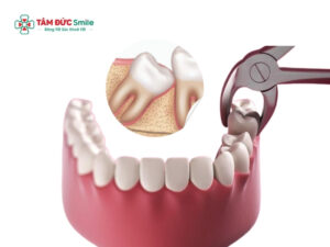 Nhổ răng số 8 đau răng số 7: Nguyên nhân và cách xử lý