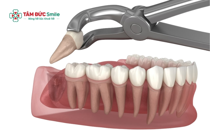 Công nghệ nhổ răng bằng sóng siêu âm Piezotome hiện đại giúp hạn chế chảy máu, giảm sưng đau và đẩy nhanh tốc độ lành thương.