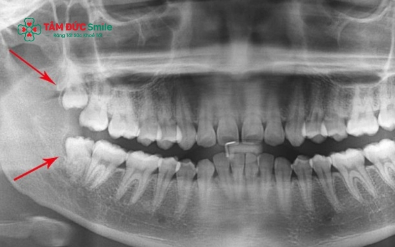 Chụp phim CT Cone Beam là bước không thể thiếu trong quy trình nhổ răng số 8 để bác sĩ xác định chính xác vị trí chân răng và dây thần kinh.