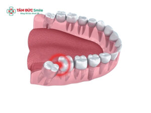 Quy trình nhổ răng số 8 an toàn và lưu ý sau nhổ