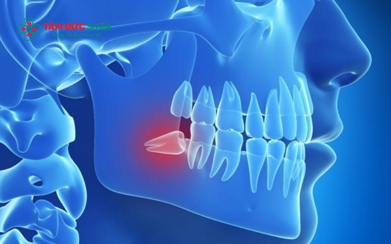 Răng số 8 nằm ở vị trí phức tạp, sát dây thần kinh nên việc tuân thủ quy trình nhổ răng chuẩn y khoa là bắt buộc để đảm bảo an toàn
