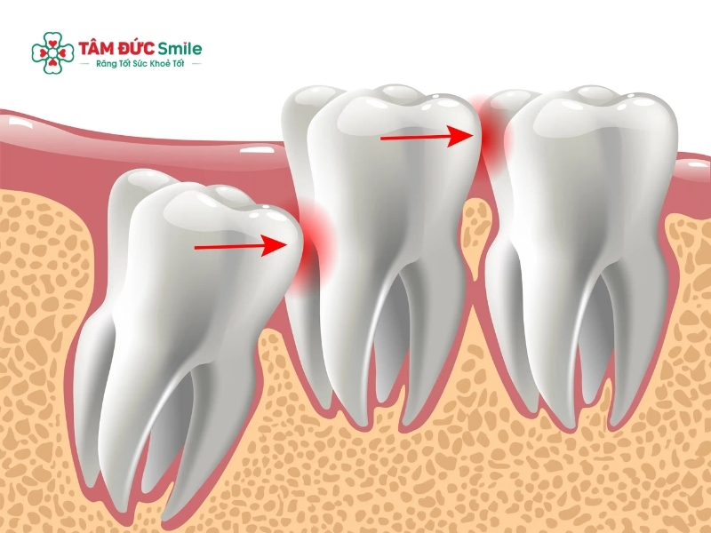 Răng số 8 lung lay thường là dấu hiệu của viêm nhiễm nghiêm trọng, nếu không xử lý kịp thời có thể gây áp xe và làm tổn thương răng số 7 kế cận