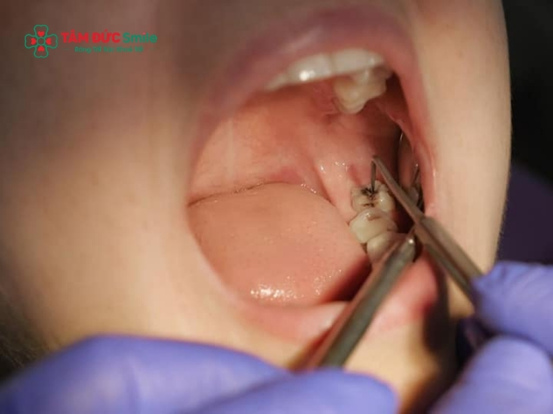 Tuyệt đối không tự ý nhổ răng số 8 lung lay tại nhà vì dễ gây nhiễm trùng máu; bạn cần được bác sĩ thăm khám và thực hiện nhổ răng trong môi trường vô trùng.