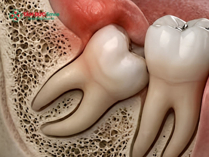 Răng số 8 bị lung lay có nguy hiểm không? Có nên nhổ không?