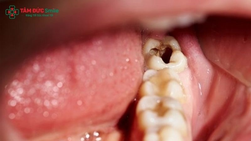 rang-so-8-bi-sau-co-nen-nho-khong-1