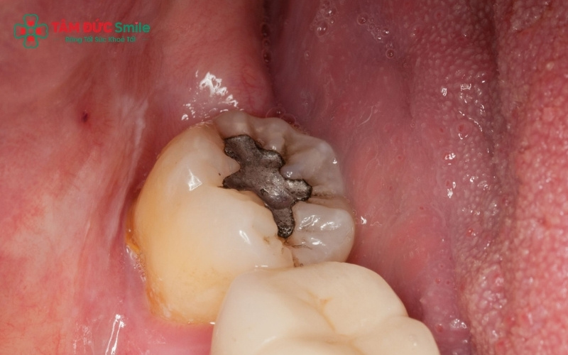 Răng số 8 bị sâu nhẹ và mọc thẳng, có chức năng ăn nhai rõ ràng thường được ưu tiên bảo tồn bằng phương pháp trám răng hoặc điều trị tủy