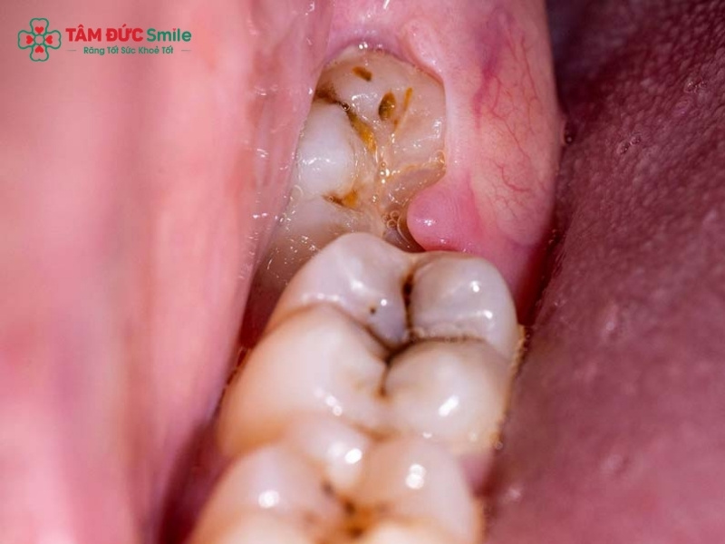 Răng số 8 bị sâu có nên nhổ không? Khi nào cần xử lý sớm