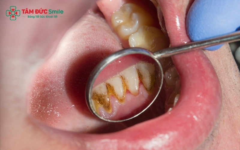 Răng số 8 bị vỡ mẻ, xuất hiện lỗ sâu đen kèm theo tình trạng sưng nướu là những dấu hiệu rõ ràng nhất cảnh báo răng khôn đã tổn thương nặng