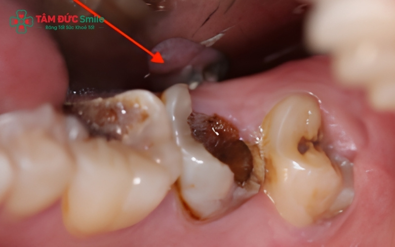 Vị trí nằm sâu trong cùng hàm cùng tư thế mọc lệch khiến răng số 8 trở thành "điểm đen" tích tụ vi khuẩn, dẫn đến sâu răng và vỡ thân răng.