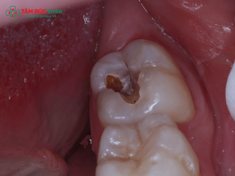 Răng số 8 bị sâu vỡ: Có nên nhổ răng khôn để tránh biến chứng?