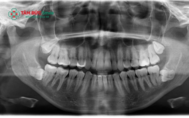 Phim chụp X-quang cho thấy rõ tình trạng răng số 8 mọc ngang 90 độ đâm thẳng vào răng số 7, gây ra những cơn đau âm ỉ vùng góc hàm.