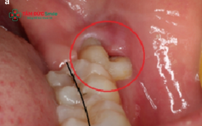 Răng số 8 mọc ngang nếu không xử lý sớm sẽ phá hủy răng số 7 kế cận, gây sâu răng, viêm tủy và thậm chí là mất răng ăn nhai chính.