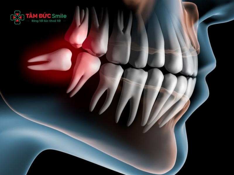 Răng số 8 mọc ngang: Dấu hiệu, biến chứng và cách chăm sóc sau khi nhổ răng