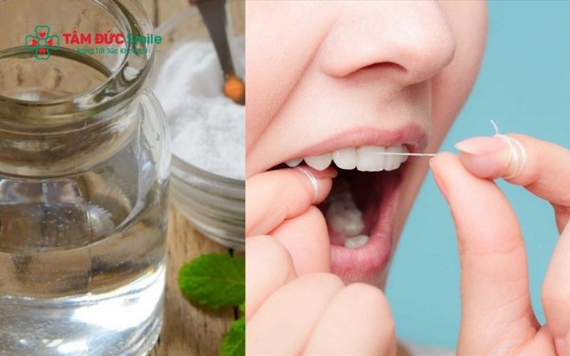 Vệ sinh răng và súc miệng bằng nước muối sinh lý giúp làm dịu cơn đau, giảm sưng tấy nhanh chóng trước khi đến gặp bác sĩ.