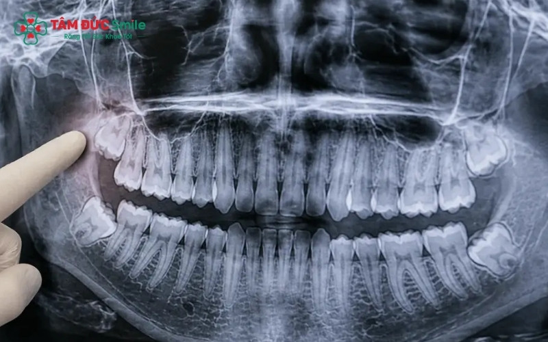 Ở tuổi 11, phần lớn trẻ đang mọc răng hàm số 7 thay vì răng khôn (răng số 8). Việc răng khôn xuất hiện sớm ở tuổi này là trường hợp khá hiếm gặp