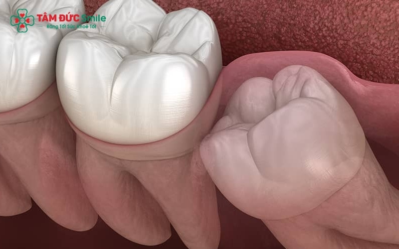 Trẻ thường có cảm giác ê ẩm, nướu hơi sưng đỏ và sốt nhẹ khi các răng hàm lớn bắt đầu quá trình mọc xuyên qua lợi.