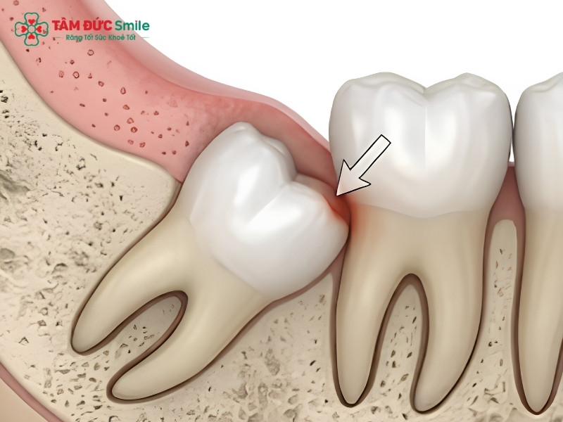 11 tuổi mọc răng khôn có nguy hiểm không? Có nên nhổ không?