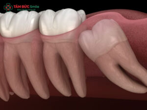 13 tuổi mọc răng khôn có sao không? Khi nào cần nhổ?