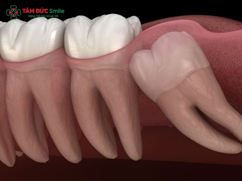 13 tuổi mọc răng khôn có sao không? Khi nào cần nhổ?