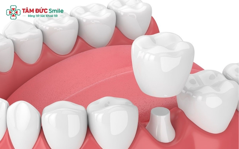 Bọc răng sứ cho trẻ 14 tuổi là vấn đề cần được cân nhắc kỹ lưỡng vì đây là giai đoạn răng và xương hàm vẫn đang có nhiều thay đổi.