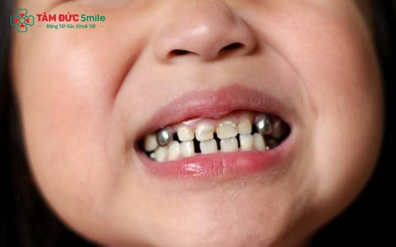 Ở tuổi 14, buồng tủy răng còn lớn, việc mài răng để bọc sứ rất dễ gây xâm lấn, dẫn đến viêm tủy và ảnh hưởng đến sự phát triển của chân răng.