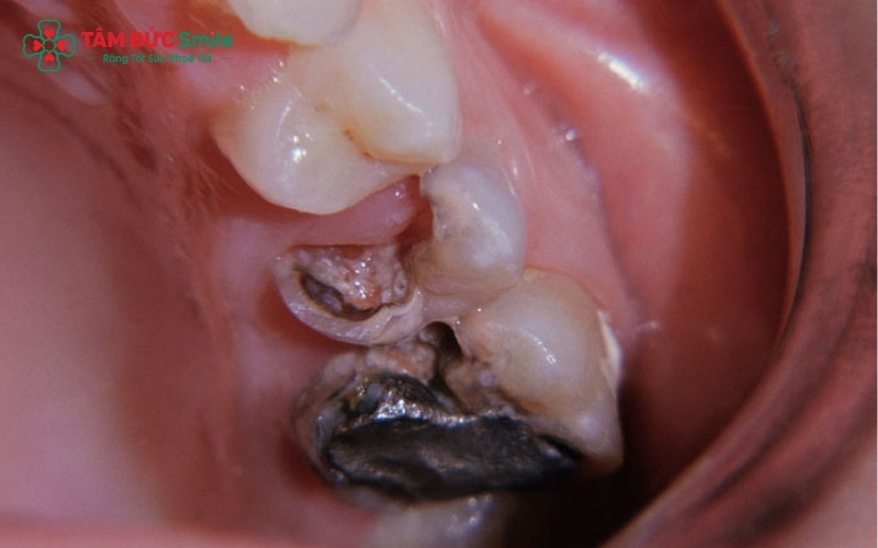 Bọc răng sứ ở tuổi 14 chỉ nên thực hiện trong các trường hợp cấp thiết như răng gãy vỡ quá lớn do chấn thương mà các phương pháp trám răng không thể khắc phục.
