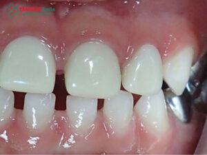 14 tuổi có bọc răng sứ được không? Những trường hợp có thể cân nhắc
