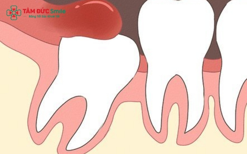 ăng khôn mọc lệch ở tuổi 16 có thể gây áp lực lên toàn bộ cung hàm, làm xô lệch các răng khác, đặc biệt nguy hiểm với những bạn đang trong quá trình niềng răng.