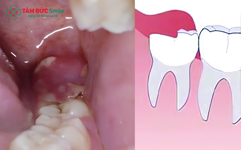 Ở tuổi 40, răng khôn mọc ngầm có nguy cơ cao hình thành u nang xương hàm hoặc gây tiêu xương răng số 7 nếu không được phát hiện và xử lý kịp thời.