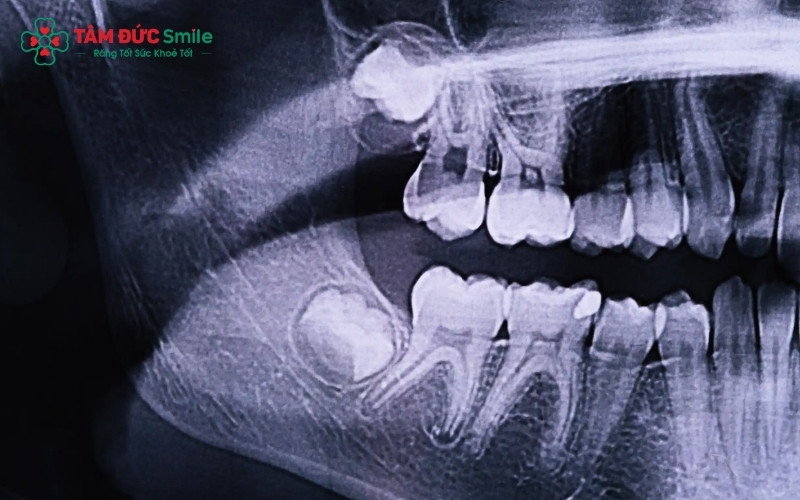 ù hiếm gặp nhưng mọc răng khôn ở tuổi 40 vẫn có thể xảy ra do răng bị kẹt sâu trong xương hàm và đến nay mới bắt đầu dịch chuyển.