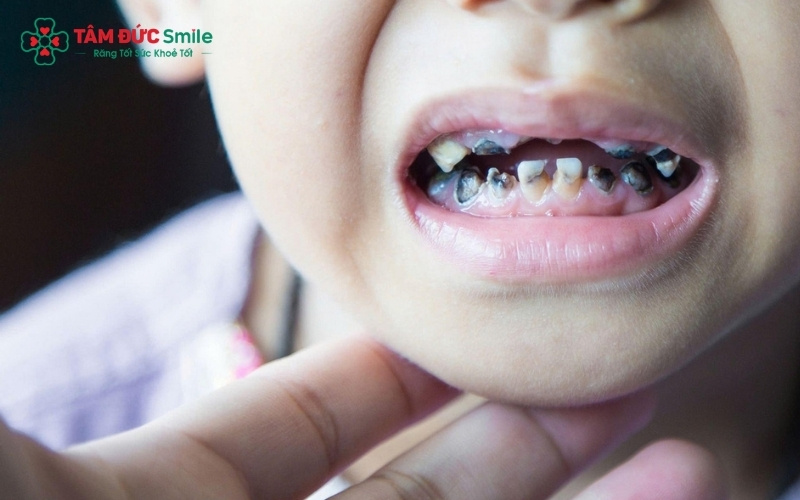 ăng cửa bị sâu sau khi được trám thẩm mỹ không chỉ giúp bé ăn nhai tốt hơn mà còn đảm bảo tính thẩm mỹ, giúp bé tự tin khi giao tiếp.