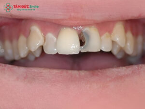Bé 3 tuổi bị sâu răng cửa phải làm sao? Cách điều trị an toàn