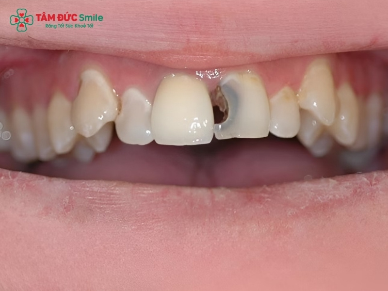 Bé 3 tuổi bị sâu răng cửa phải làm sao? Cách điều trị an toàn