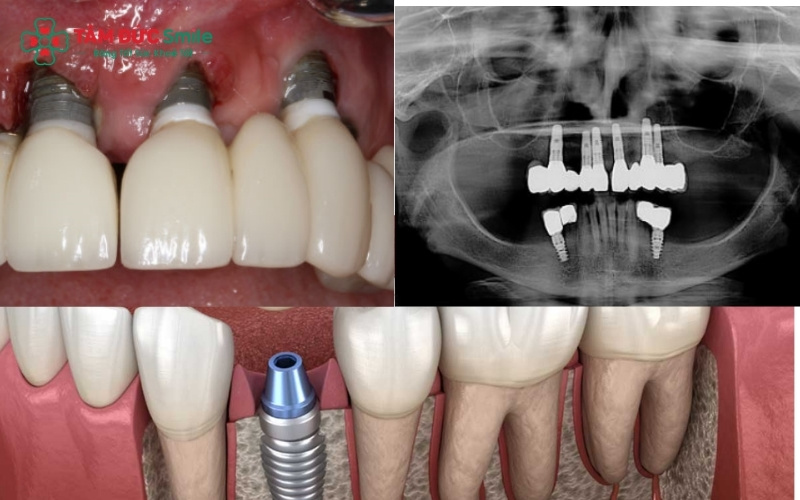 Người bị bệnh nha chu hoàn toàn có thể trồng răng Implant nếu tình trạng viêm nhiễm được điều trị triệt để và kiểm soát ổn định.