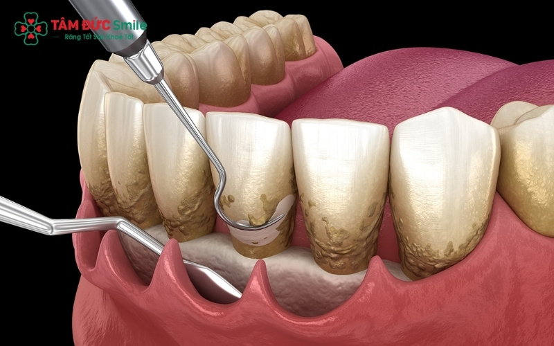 Việc kiểm tra kỹ lưỡng mô nướu và mật độ xương là điều kiện bắt buộc để đảm bảo trụ Implant có nền tảng bám trụ vững chắc.