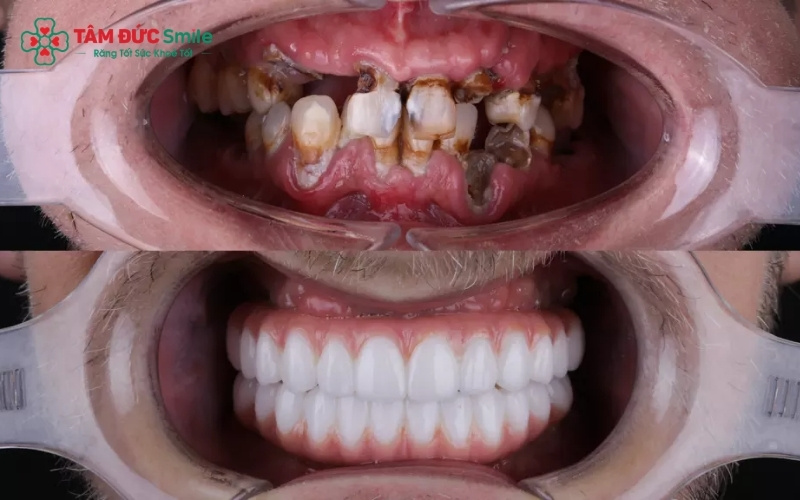 Viêm quanh Implant là rủi ro lớn nhất nếu bệnh nha chu tái phát, có thể dẫn đến tình trạng đào thải trụ và thất bại trong điều trị.