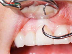 Bệnh nha chu có trồng răng Implant được không? Điều kiện để trồng răng Implant