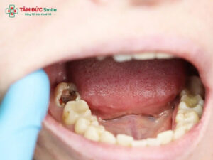 Bị sâu răng phải làm sao? Điều trị hiệu quả tại Nha khoa Tâm Đức Smile