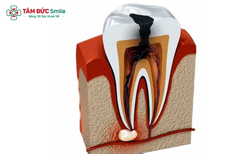 Tùy vào mức độ tổn thương, bác sĩ sẽ chỉ định trám răng hoặc điều trị tủy để bảo tồn răng thật và ngăn chặn biến chứng áp xe