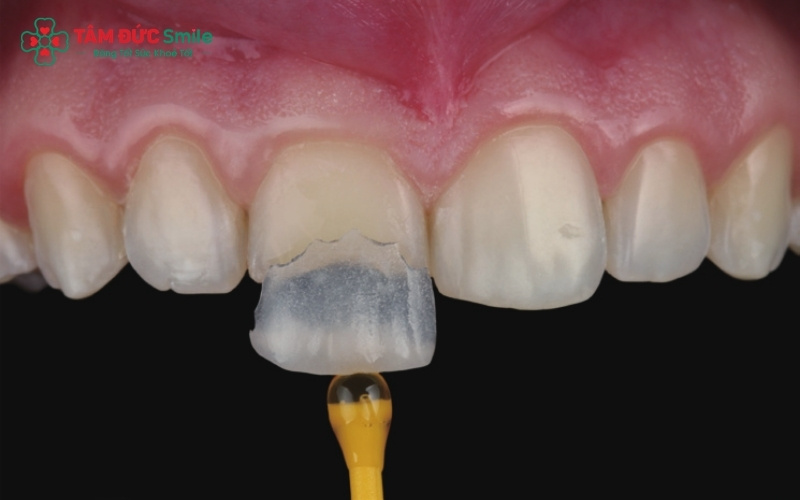Bọc răng sứ bán phần (Inlay/Onlay) là kỹ thuật phục hình chỉ thay thế phần mô răng bị tổn thương, giúp giữ lại tối đa cấu trúc răng thật tự nhiên.