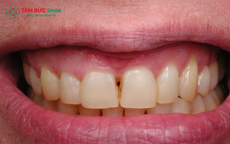 Phương pháp này là giải pháp lý tưởng cho những chiếc răng bị sâu, vỡ lớn hoặc mòn men nhưng vẫn còn đủ mô răng khỏe mạnh để làm trụ đỡ.